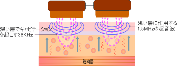 Wデュアルキャビテーション